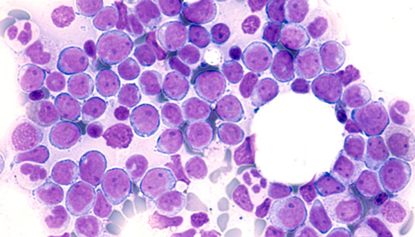 acute myeloid leukemia cells